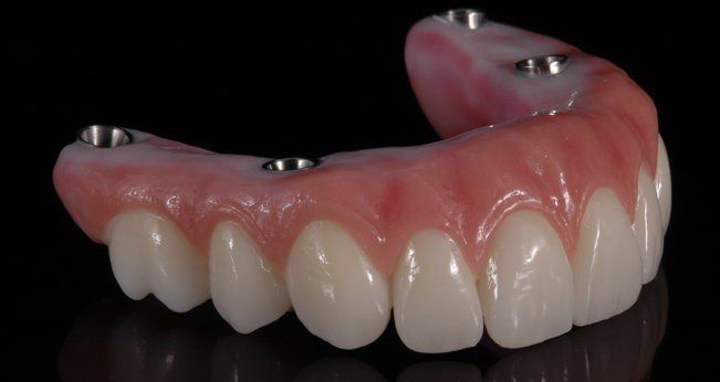 Dental Implant Hybrid Fixed