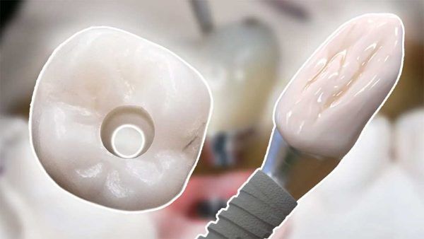 Two INCREDIBLE Options for Screw Retained Implant Crowns