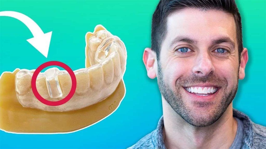 miniComfort - This Isn't Your Grandmother's Mouth Guard